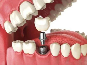 Why is titanium the preferred material for dental implants? Why is titanium the preferred material for dental implants?